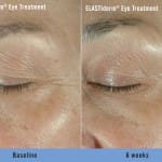 elastider before after 1 elastider before after 1