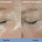 elastider before after 2 elastider before after 2