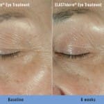 elastider before after 3 elastider before after 3