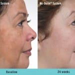nu-derm-before-after 2