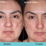 nu-derm-before-after 3