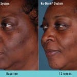 nu-derm-before-after 4