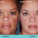nu-derm-before-after 5
