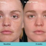 nu-derm-before-after 6