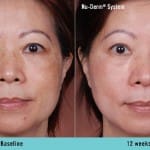 nu-derm-before-after 7
