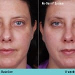 nu-derm-before-after 8