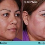 nu-derm-before-after 9